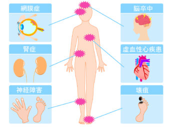 糖尿病とはどんな病気？②～合併症と糖尿病の予防法～